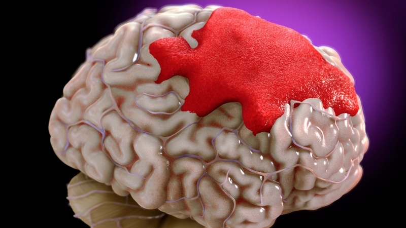 Những cơ chế giảm tiểu cầu trong sốt xuất huyết là gì? Hậu quả của việc giảm tiểu cầu khi bị sốt xuất huyết 4