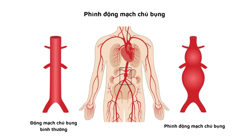 Những đặc điểm của giải phẫu mạch máu ổ bụng -2