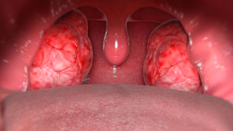 Những dấu hiệu bệnh bạch hầu cần nhận biết và phương pháp phòng bệnh hiệu quả 2