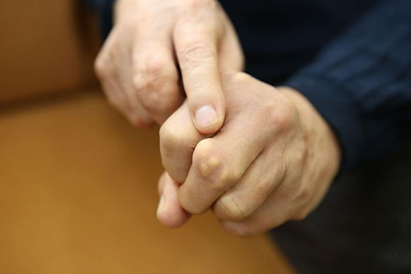 Những dấu hiệu bệnh gút ở tay bạn nên biết 6