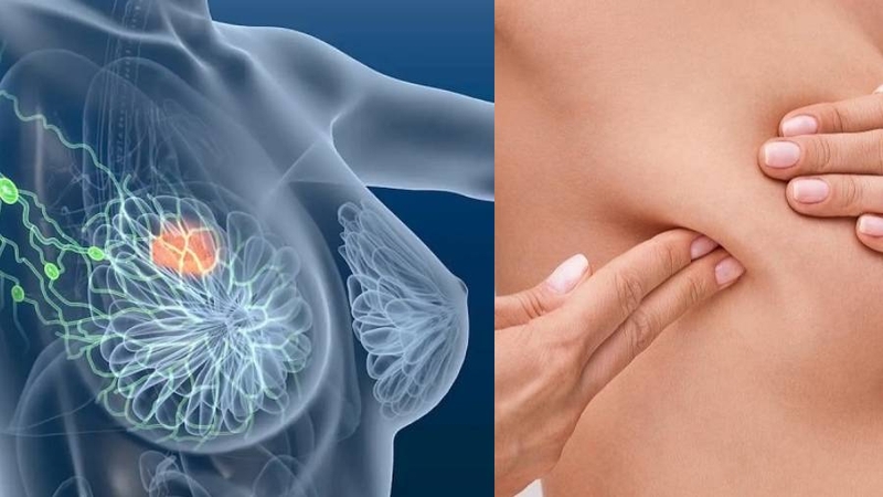 Một dấu hiệu ung thư vú điển hình nhất là xuất hiện khối u hoặc cục cứng ở vùng ngực