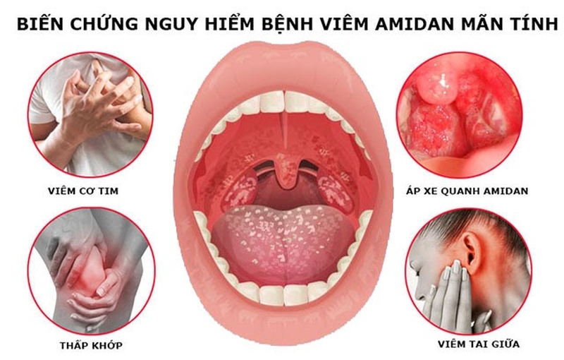 Những dấu hiệu của bệnh viêm amidan và cách chăm sóc hiệu quả