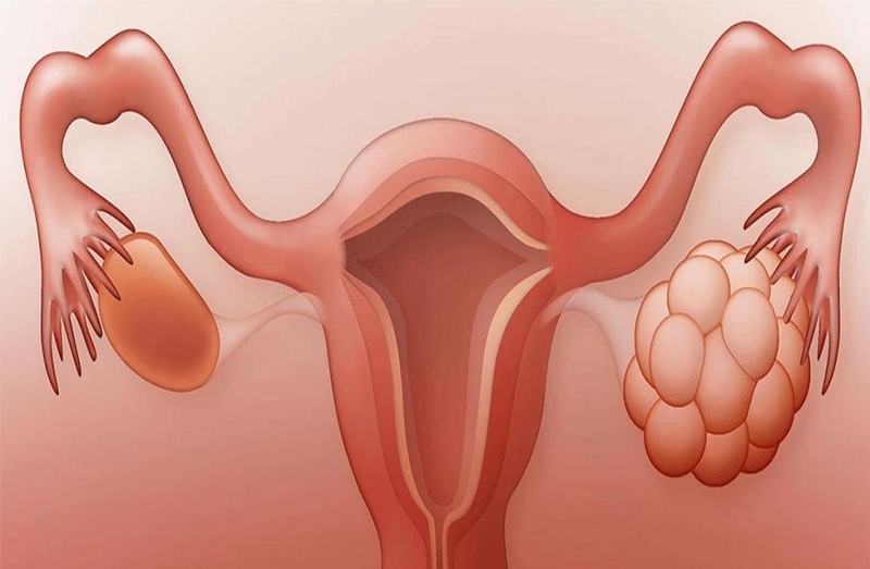 Những dấu hiệu đa nang buồng trứng phổ biến nhất mà chị em cần biết 1