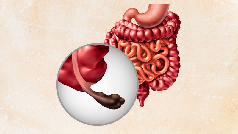 Những dấu hiệu đau ruột thừa là gì? Các giai đoạn của viêm ruột  như thế nào? 2