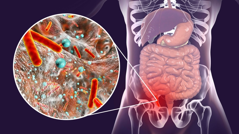 Những dấu hiệu đau ruột thừa là gì? Các giai đoạn của viêm ruột  như thế nào? 3