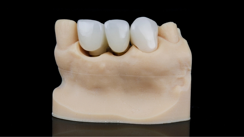 Khe hở chân răng, tụt nướu hoặc ê buốt khi ăn nhai là những dấu hiệu răng sứ bị hở