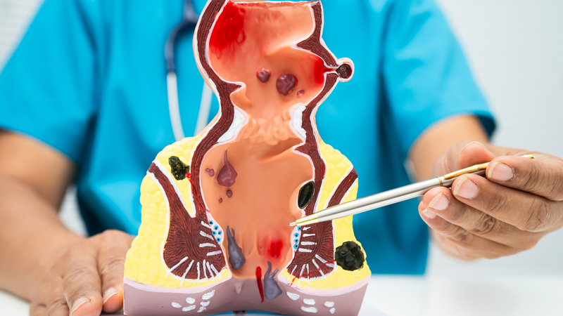 Trĩ nội tương đối dễ kiểm soát nếu được phát hiện sớm và điều trị đúng cách