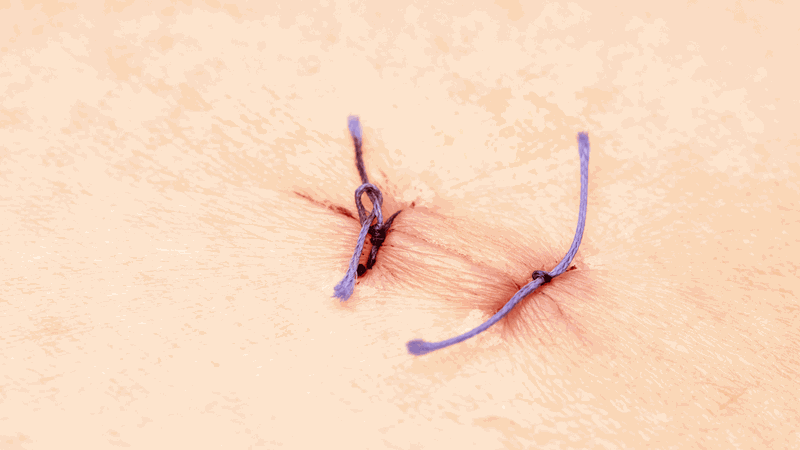 Những dấu hiệu vết khâu tầng sinh môn đang lành và cách chăm sóc 2