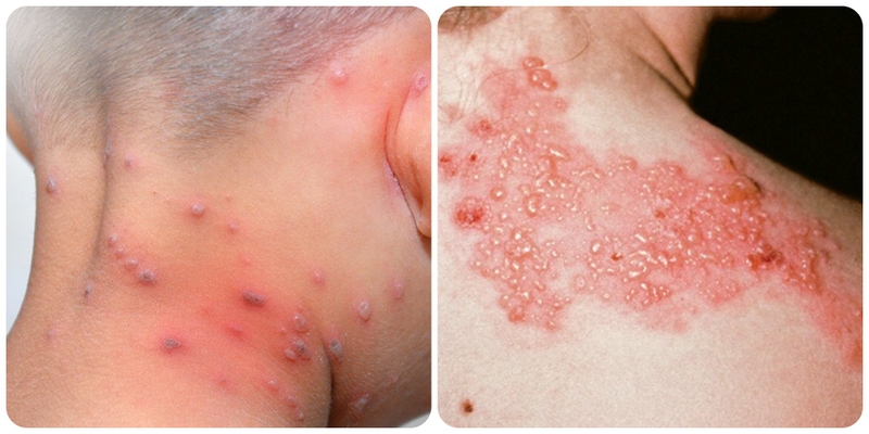 Những điểm giống và khác nhau giữa zona thần kinh và thủy đậu 2