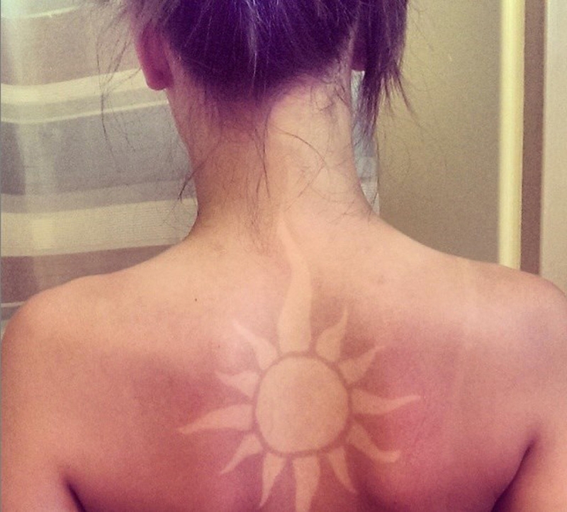 Những điều bạn cần biết về bệnh dị ứng với ánh nắng mặt trời 3