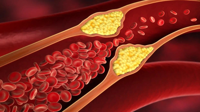 Những điều bạn cần biết về bệnh mỡ máu gia đình! 1