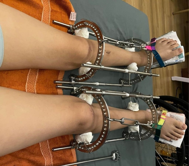 Những điều bạn cần biết về phẫu thuật kéo chân tăng chiều cao 2