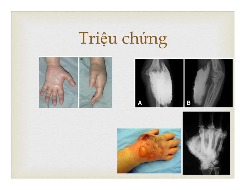 Những điều bạn cần biết về thoát mạch chất tương phản