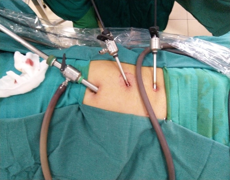 Những điều bạn cần biết về thoát vị bẹn nghẹt 3