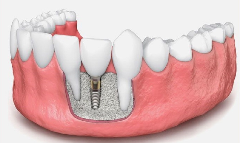 Những điều bạn cần lưu ý khi thực hiện ghép xương tự thân 1