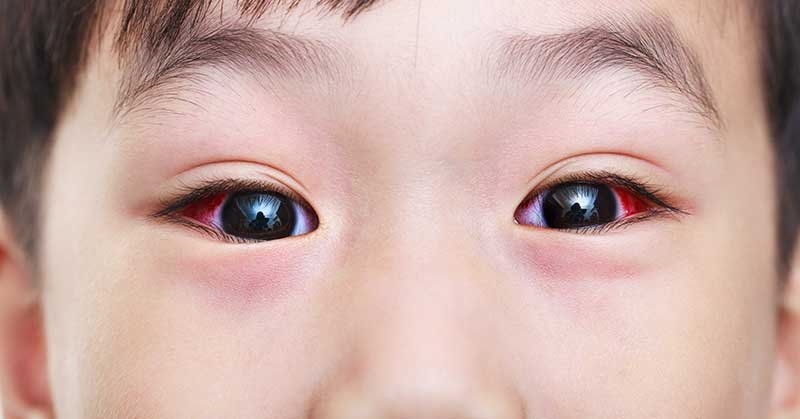 Những điều bạn nên lưu ý sau khi bị đau mắt đỏ 1