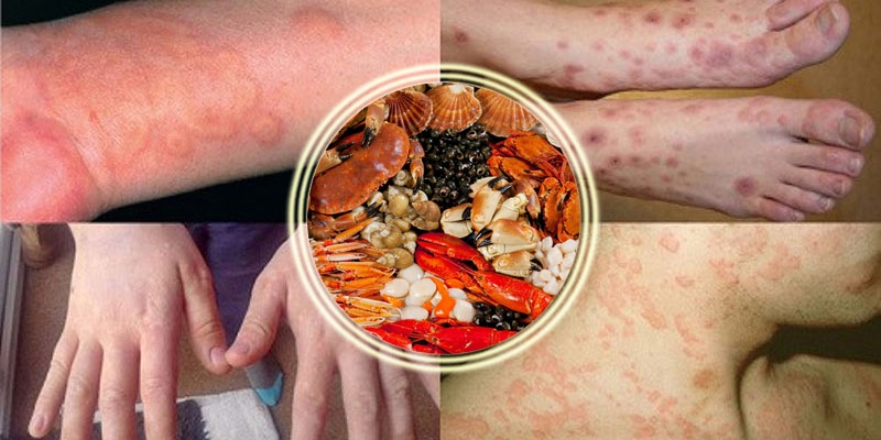 Những điều cần biết nếu bạn bị dị ứng hải sản sống 1