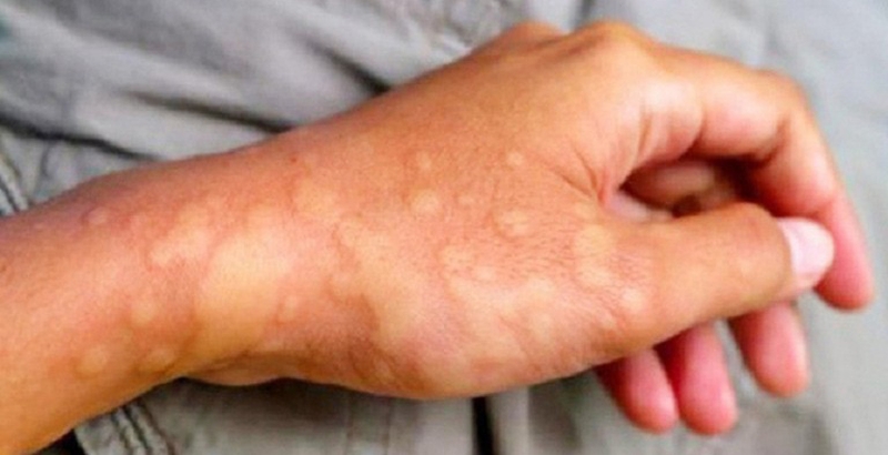 Những điều cần biết nếu bạn bị dị ứng hải sản sống 2