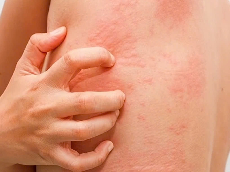 Những điều cần biết về bạch cầu ái kiềm tăng 3