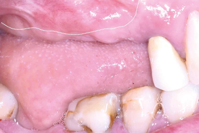 Những điều cần biết về bệnh tiền đình u nhú 2