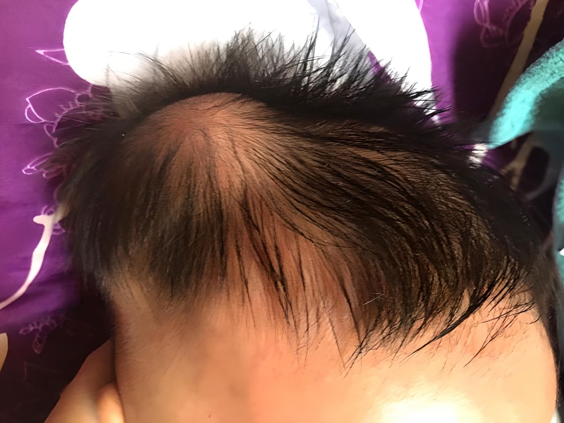 Những điều cần biết về bướu huyết thanh ở trẻ sơ sinh 2