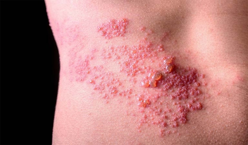 Những điều cần biết về các biến chứng zona thần kinh thường gặp 1