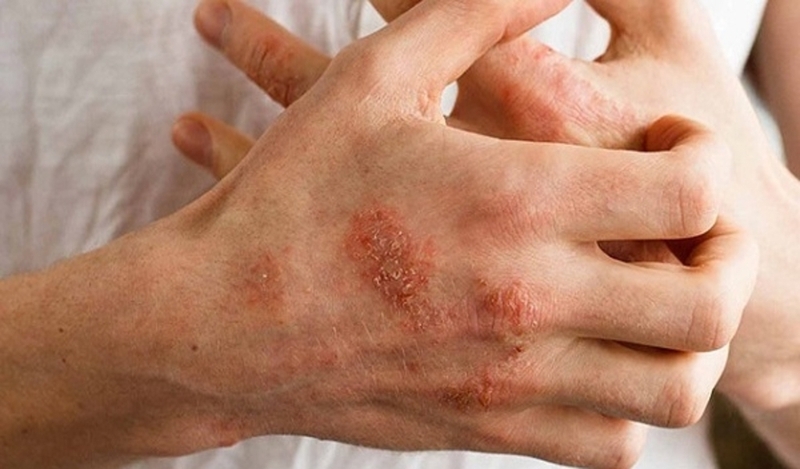 Những điều cần biết về các biến chứng zona thần kinh thường gặp 2