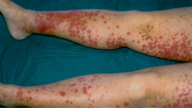 Những điều cần biết về Cryoglobulinemia 2