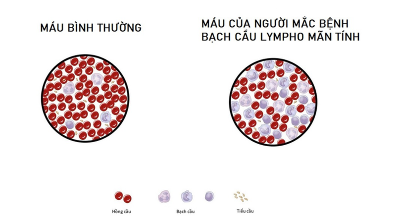 Những điều cần biết về Cryoglobulinemia 3