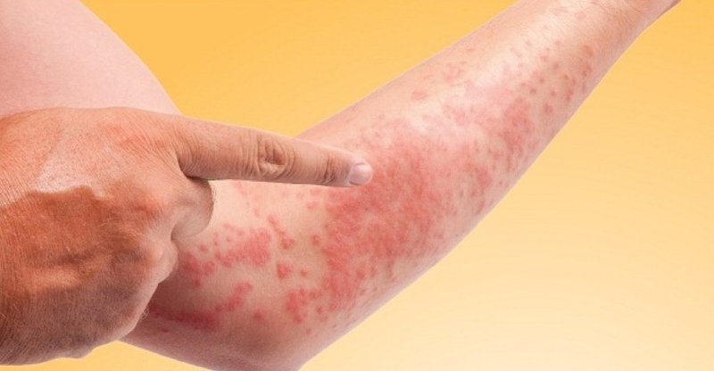 Những điều cần biết về dị ứng amoxicillin 2