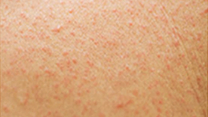 Những điều cần biết về dị ứng amoxicillin 3