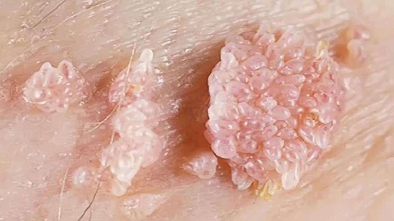 Những điều cần biết về đốt sùi mào gà và cách chăm sóc vết thương sau khi đốt 1