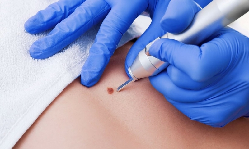 Những điều cần biết về đốt sùi mào gà và cách chăm sóc vết thương sau khi đốt 2