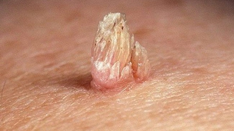 Những điều cần biết về đốt sùi mào gà và cách chăm sóc vết thương sau khi đốt 3