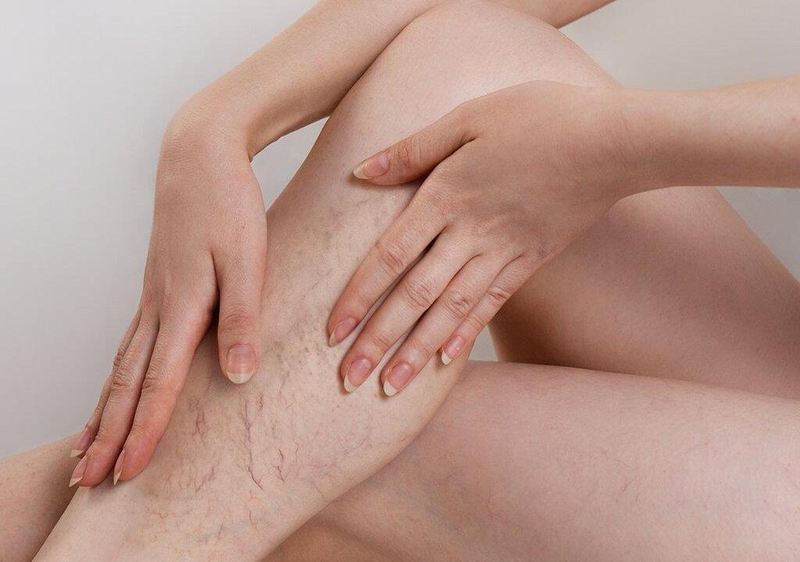Những điều cần biết về keo sinh học tĩnh mạch và bệnh suy giãn tĩnh mạch chi dưới 1
