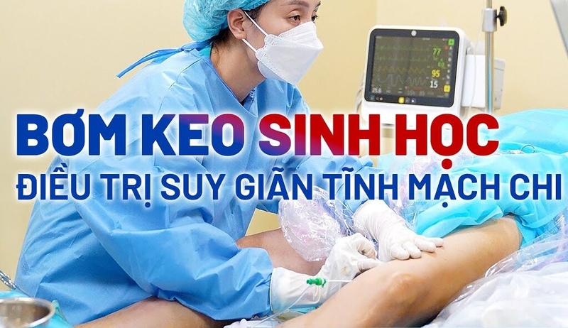 Những điều cần biết về keo sinh học tĩnh mạch và bệnh suy giãn tĩnh mạch chi dưới 2