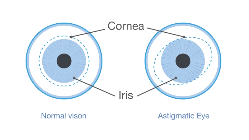 Những điều cần biết về kính loạn thị 1