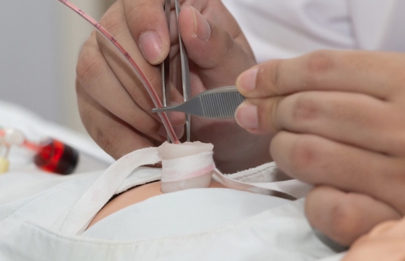 Những điều cần biết về kỹ thuật đặt catheter tĩnh mạch rốn cho trẻ sơ sinh 1