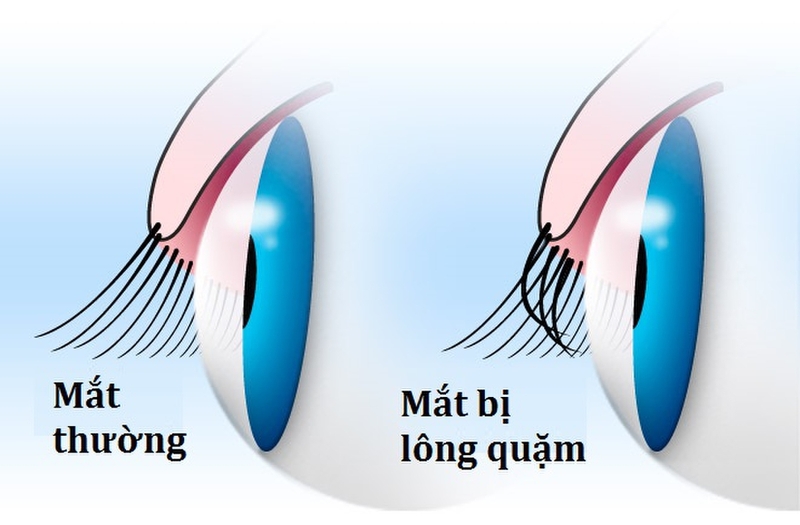 Những điều cần biết về lông quặm để có cách điều trị kịp thời 1