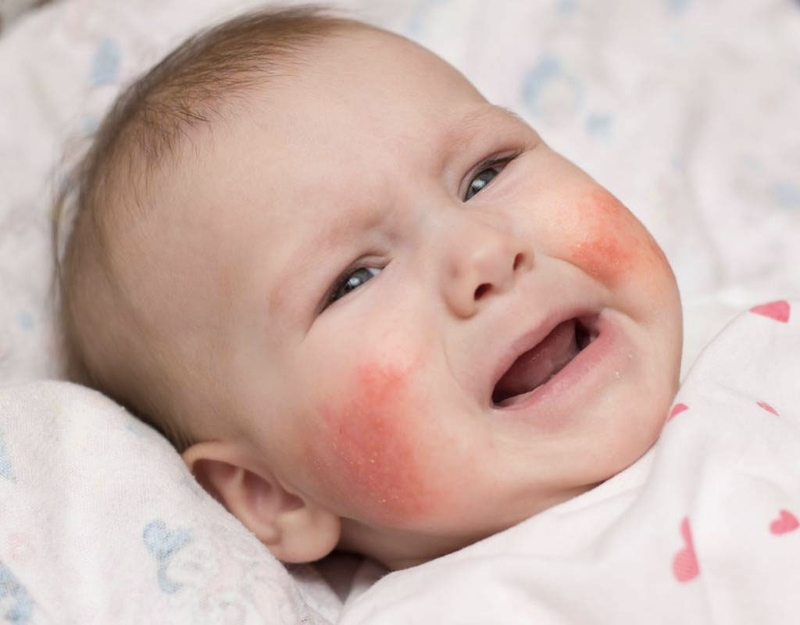 Những điều cần biết về lupus ban đỏ hệ thống trẻ em 1