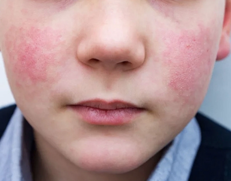 Những điều cần biết về lupus ban đỏ hệ thống trẻ em 2