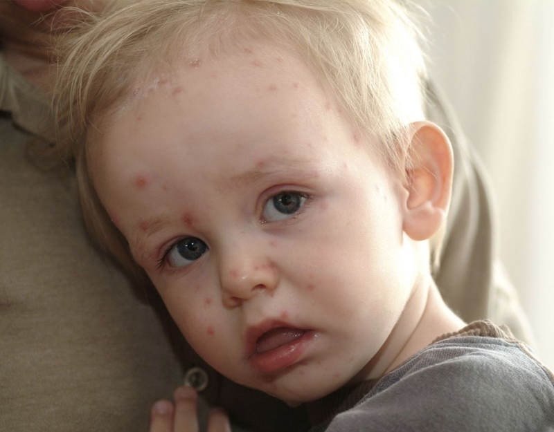 Những điều cần biết về lupus ban đỏ hệ thống trẻ em 3