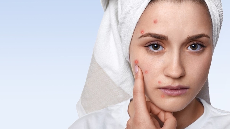 Những điều cần biết về mụn do stress và cách khắc phục 7