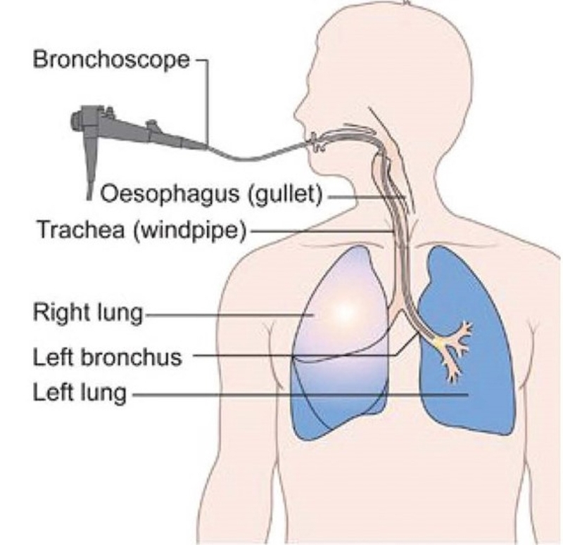 Những điều cần biết về nội soi phế quản 2