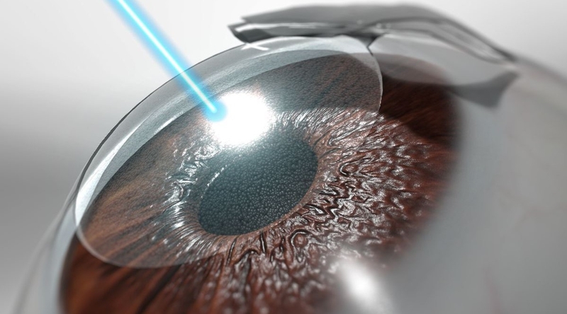 Những điều cần biết về phẫu thuật mắt cận 3