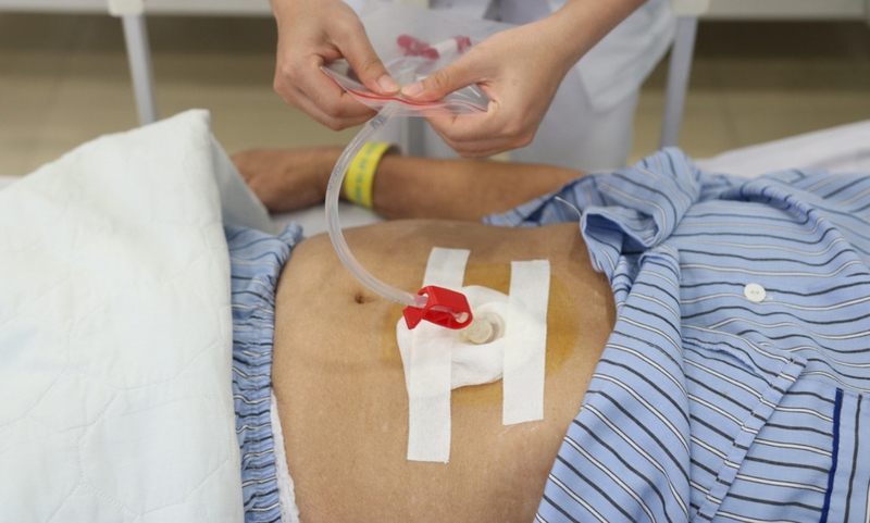 Những điều cần biết về phương pháp mở thông dạ dày qua nội soi 1