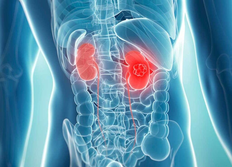 Những điều cần biết về phương pháp phẫu thuật nội soi cắt u thận 1