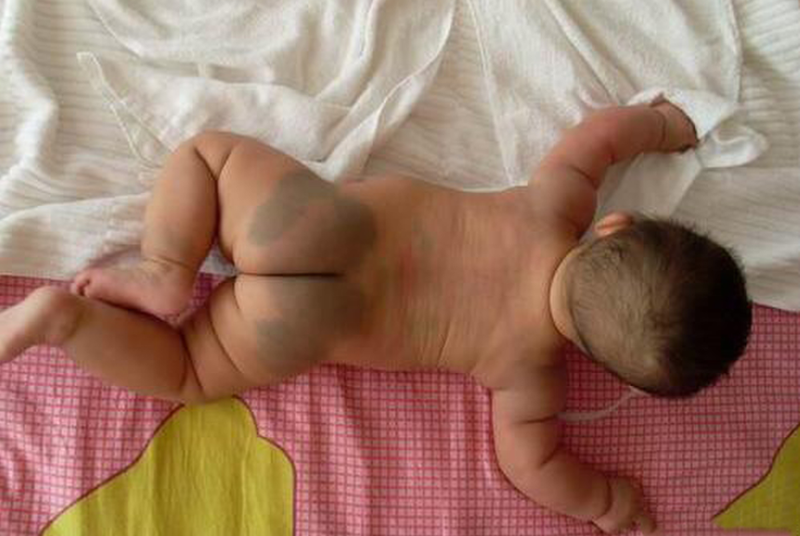 Những điều cần biết về hiện tượng rối loạn sắc tố da bẩm sinh 2