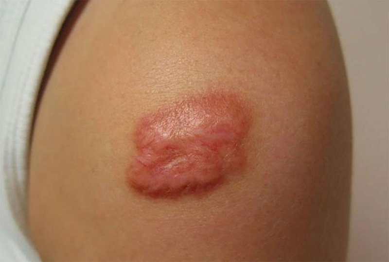 Những điều cần biết về sẹo lồi màu đỏ 1