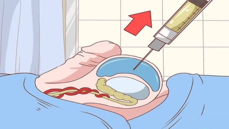 Những điều cần biết về sinh thiết tinh hoàn 1